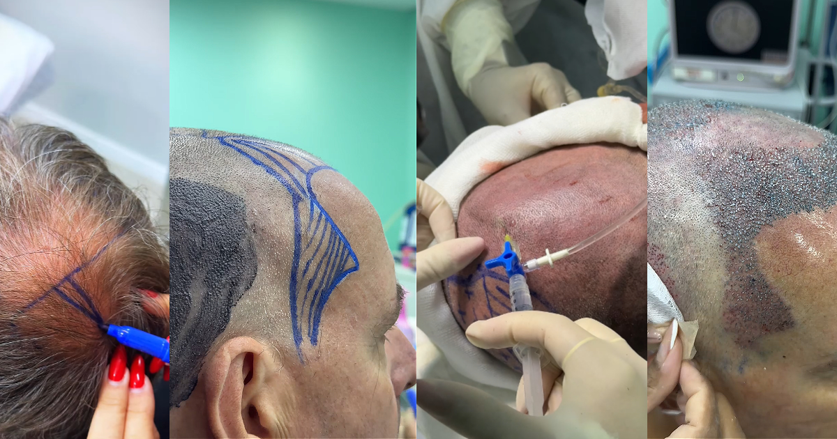 Planejamento da área doadora para transplante capilar FUE