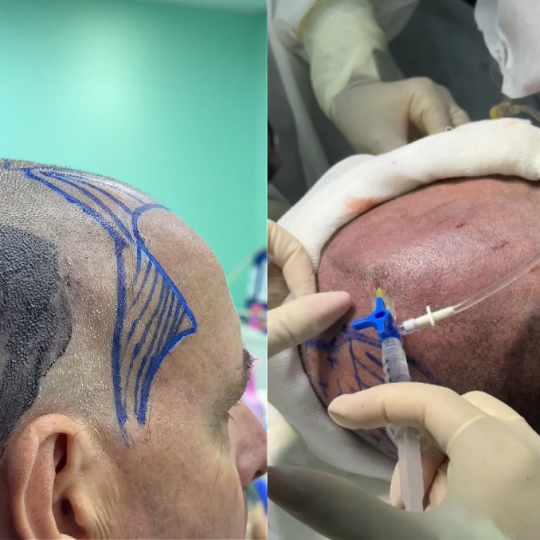 Planejamento da área doadora para transplante capilar FUE